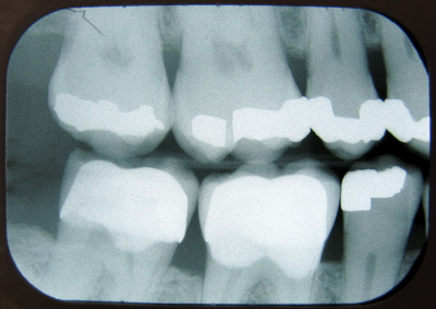 X-rays of teeth